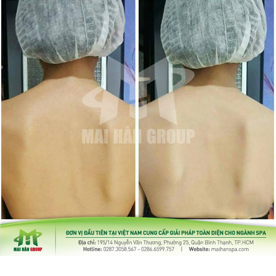 Hình ảnh minh họa trước và sau khi sử dụng sản phẩm máy phun trắng da Nano Aura