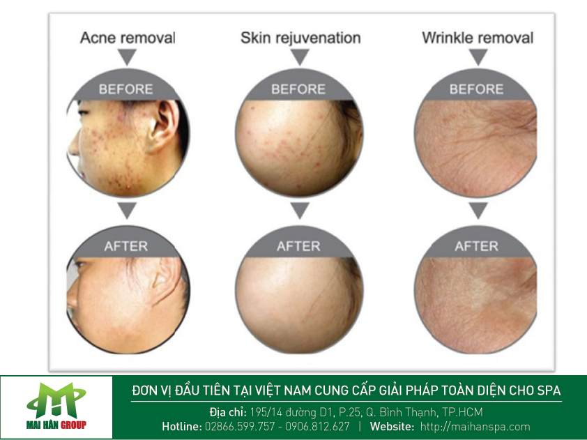 Hình ảnh trước và sau liệu trình điều trị với máy ánh sáng sinh học JK-038