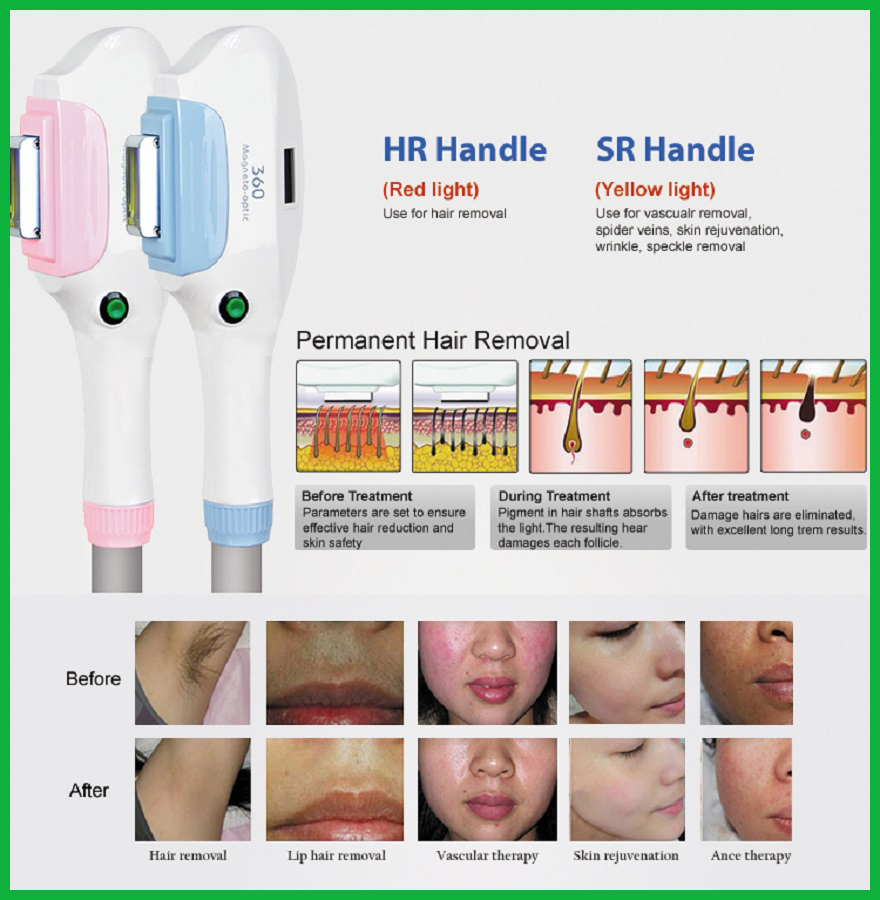 Trước và sau quá trình điều trị với Máy triệt lông tay cầm OPT 360 Trước và sau quá trình điều trị với Máy triệt lông tay cầm OPT 360