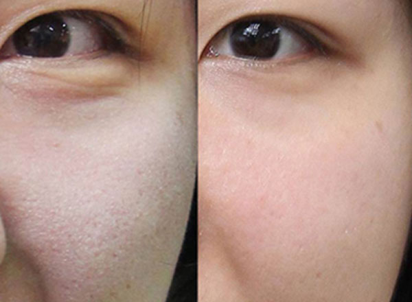 Hình ảnh trước và sau khi điều trị