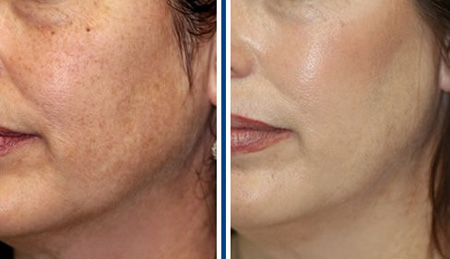 Hình ảnh trước và sau khi điều trị