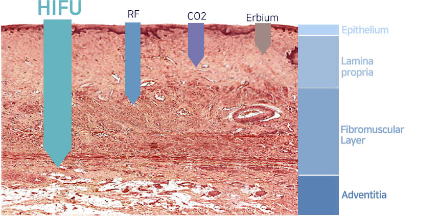 3 điểm vượt trội so của Hifu