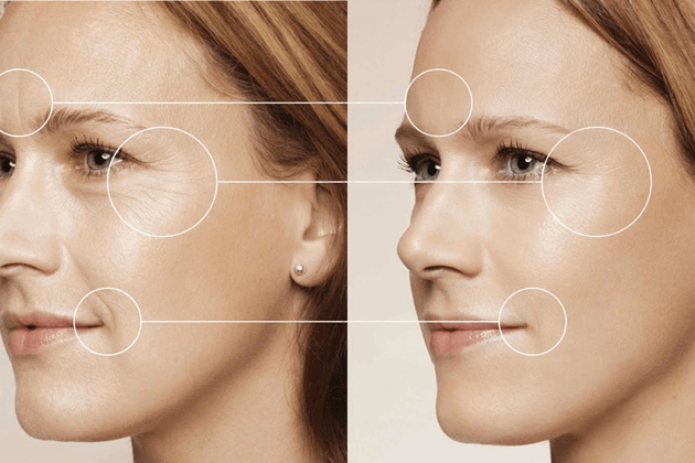 Công nghệ Hifu Double-S đánh bay các dấu hiệu lão hóa trên da