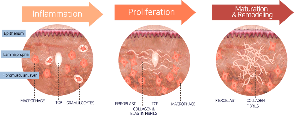 Những hiệu quả điều trị mà máy Hifu Double-S Hironic mang lại