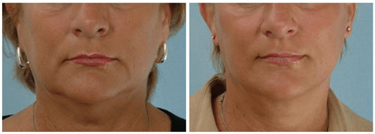 Trước và sau khi điều trị bằng máy Hifu Double-S Hironic