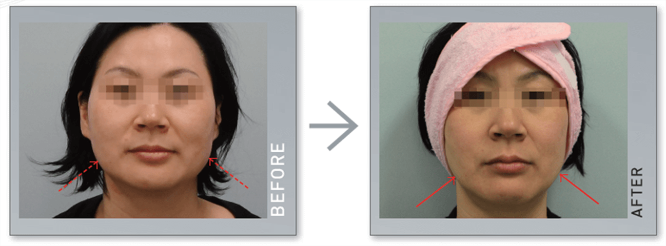 Trước và sau khi điều trị bằng máy Hifu Double-S Hironic