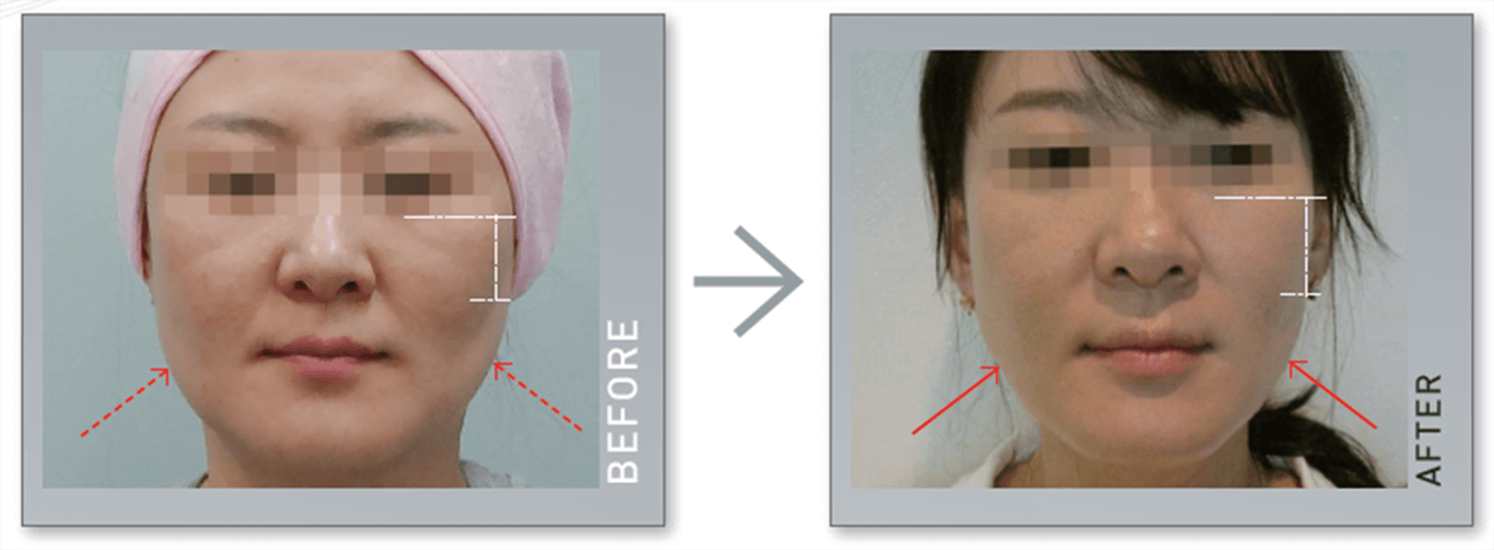 Trước và sau khi điều trị bằng máy Hifu Double-S Hironic