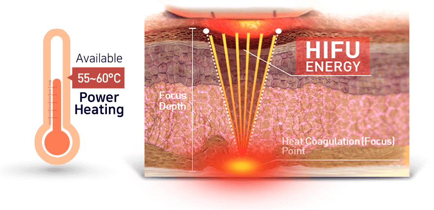 Mức năng lượng tập trung vào điểm điều trị