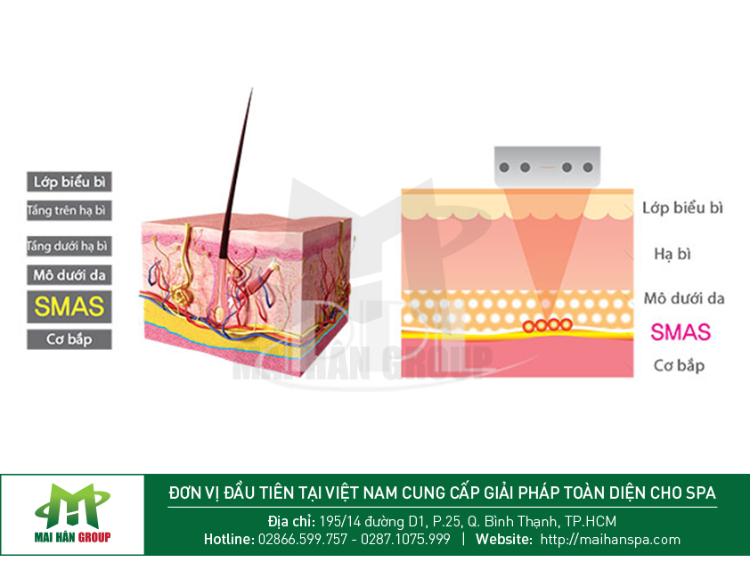 Ưu điểm của máy Hifu mang lại Ưu điểm của máy Hifu mang lại