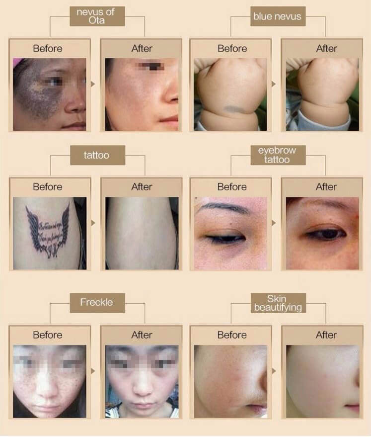 Máy xóa xăm, đốm nám bằng Laser YAG Q- Swiched L6 hình 4