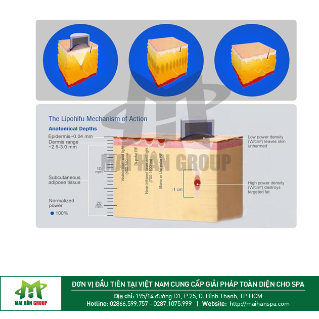 Tiến trình điều trị của máy giảm béo Liposonix