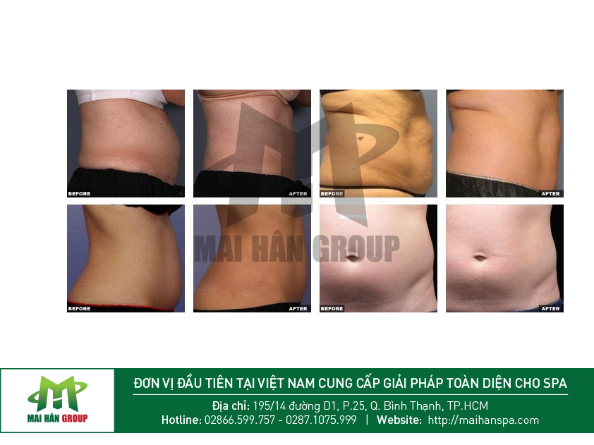 Hiệu quả của máy giảm béo Liposonix