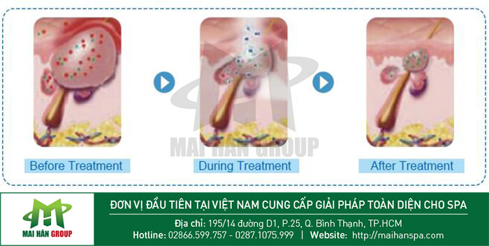 Quy trình điều trị mụn máy cung cấp Oxy đa chức năng KES-400 Quy trình điều trị mụn máy cung cấp Oxy đa chức năng KES-400