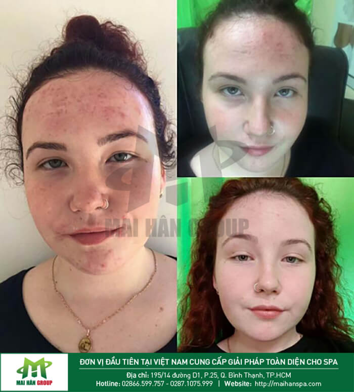 Trước và sau điều trị với máy cung cấp oxy đa chức năng KES-400 Trước và sau điều trị với máy cung cấp oxy đa chức năng KES-400