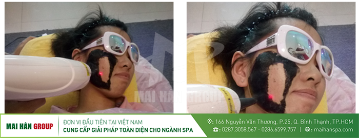 ĐIÊU TRỊ BẰNG MÁY XÓA XĂM MINI MHB -TB66