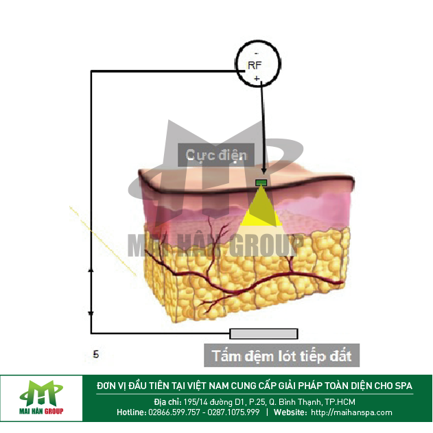 Giảm béo bằng máy RF - Baron Hàn Quốc
