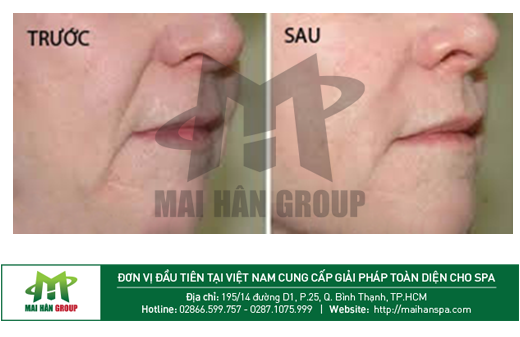 Công dụng máy giảm béo RF đơn cực – Baron Hàn Quốc