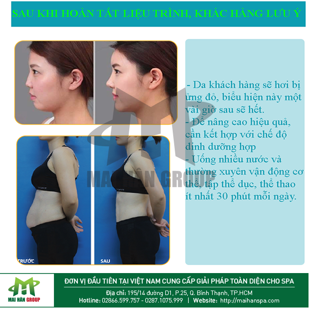 Giảm béo an toàn bằng máy RF - Baron Hàn Quốc