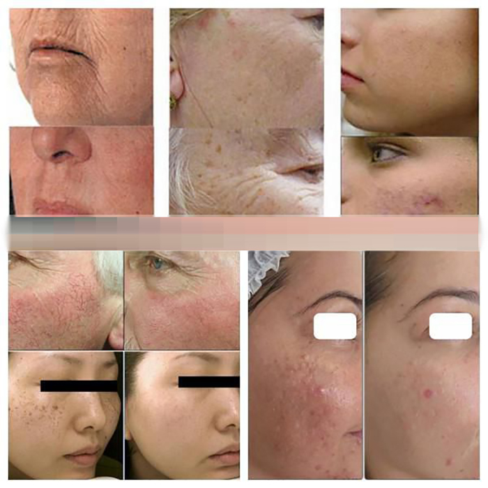 Điều trị với máy triệt lông SHR 960B