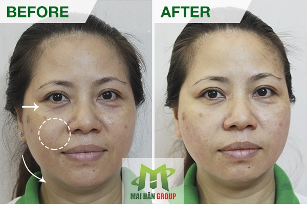 Hiệu quả máy nâng cơ và trẻ hóa da Smas Thera