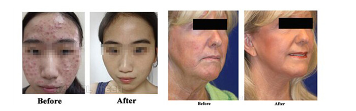 Máy Oxy-Jet đa chức năng G882A-S1 hình 3