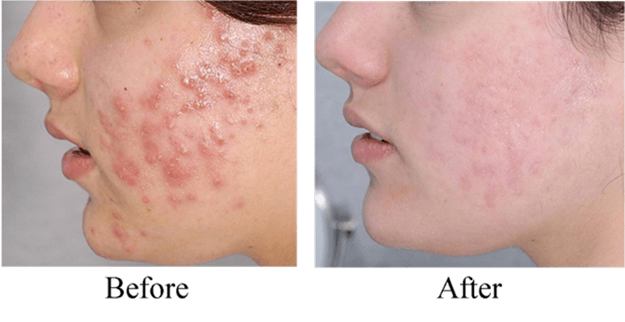 Hình ảnh trước và sau điều trị bằng máy Oxy Jet G882A-S1