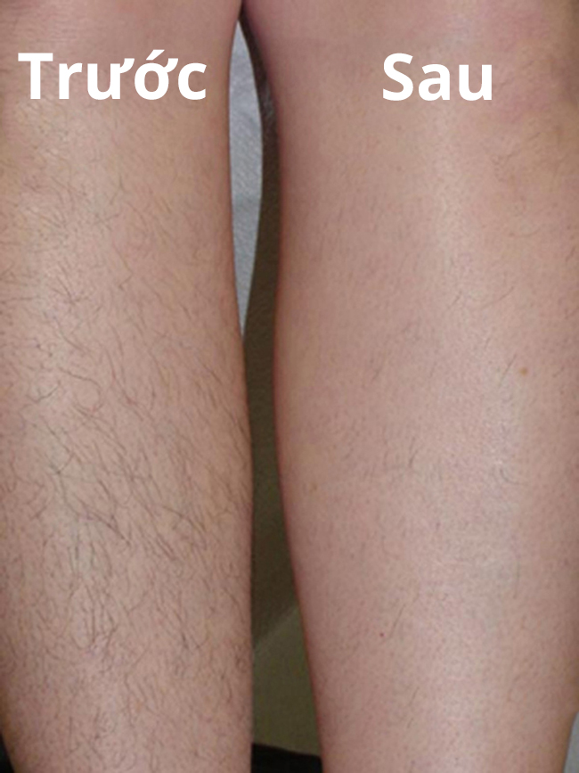 Công nghệ triệt lông tối ưu Laser Diode Công nghệ triệt lông tối ưu Laser Diode