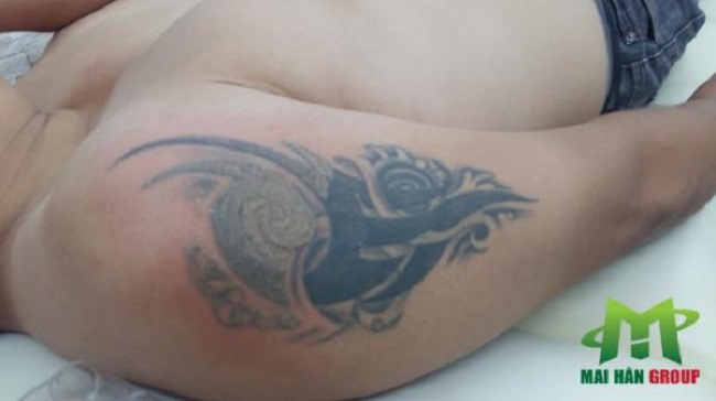 Hiệu quả xóa xăm ngay từ lần đầu tiên