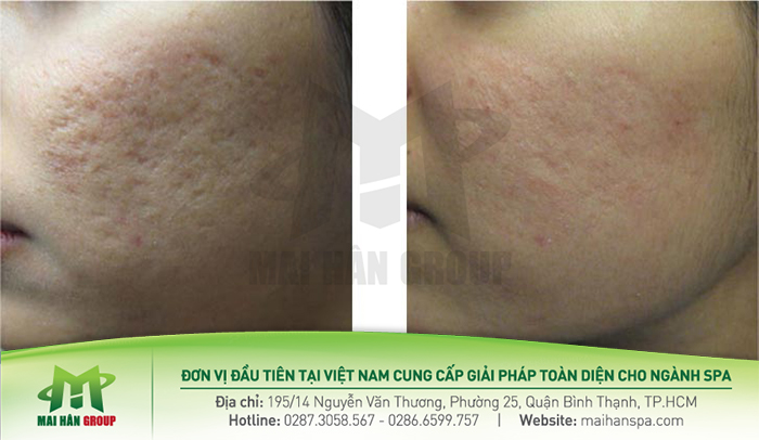 Hiệu quả của máy Laser CO2 Fractional Coscan II Hiệu quả của máy Laser CO2 Fractional Coscan II