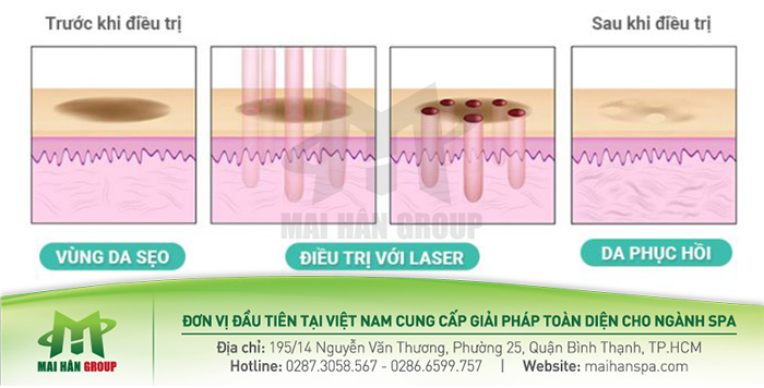 Hình ảnh minh họa trước và sau điều trị sẹo Hình ảnh minh họa trước và sau điều trị sẹo