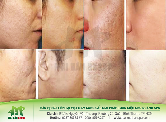 Hiệu quả của máy Laser CO2 Fractional Coscan II Hiệu quả của máy Laser CO2 Fractional Coscan II