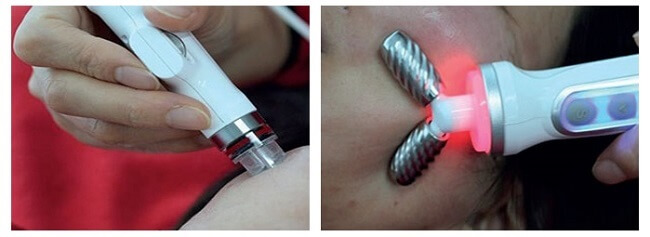 Đầu điện di Cryo nóng/ lạnh (Công nghệ độc quyền được chuyển giao từ Nhật Bản) Đầu điện di Cryo nóng/ lạnh (Công nghệ độc quyền được chuyển giao từ Nhật Bản)