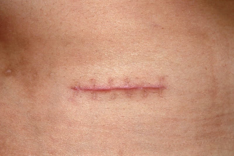 Chăm sóc vết thương đúng giúp ngăn ngừa sẹo hiệu quả