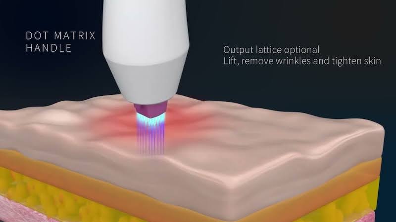 Fractional Plasma tạo ra các vi điểm tác động chọn lọc lên bề mặt da