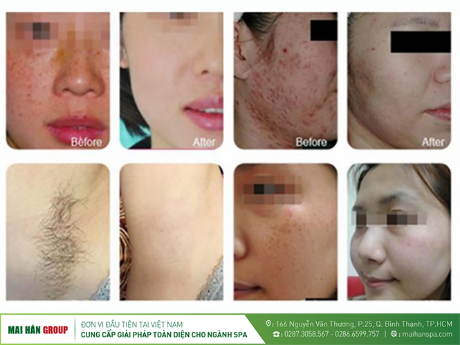 Trước và sau khi điều trị máy triệt lông TB-960 II – OPT Trước và sau khi điều trị máy triệt lông TB-960 II – OPT